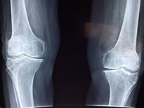 Ibutamoren increases Bone density,  Knee X-ray, Medical Anatomy