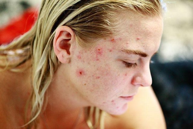 excessive usage of winstrol causes acne
